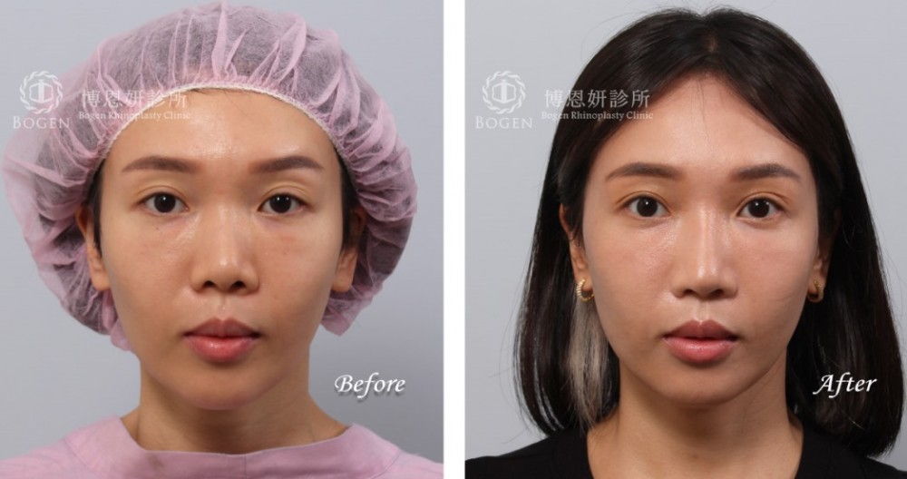 韓式隆鼻,結構式隆鼻,博恩妍